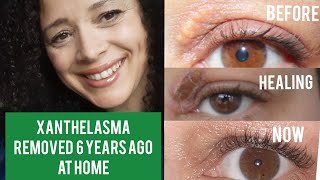 Xanthelasma Removal at Home 6 Years Ago  Fatty Eye Cholesterol Deposit  Before amp After Photos [upl. by O'Grady268]