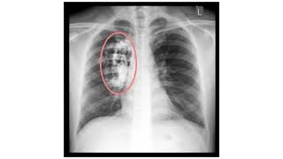 Neumonía cáncer pulmonar fibrosis quística Tuberculosis [upl. by Codd742]