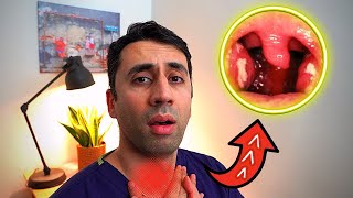 What Causes a Sore Throat HOME Remedies and Cures for Fast TREATMENT Doctor Explains [upl. by Nuawad]