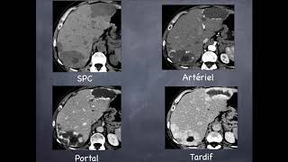 Tumeurs du foie  Bénignes  3 Hémangiome hépatique [upl. by Nylqcaj]