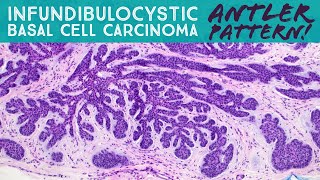 Infundibulocystic Basal Cell Carcinoma BCC w follicular differentiation Dermpath in 5 Minutes [upl. by Bernette946]