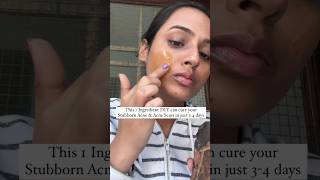 Acne Treatment at home  Remove Acne amp Acne Scars at home  Pimples treatment at home acnetreatment [upl. by Einre]