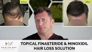 Topical Finasteride amp Minoxidil Hair Loss Solution  How To Use [upl. by Aggappora]