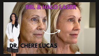 BBL and HALO Treatment Journey  Derms of Boca Raton  Dr Chere Lucas Anthony [upl. by Ramedlab]