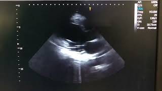 Wall motion hypokinesia in apical and septal segments [upl. by Annovaj]