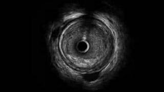 Left Main IVUS [upl. by Moser397]