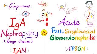 IgA Nephropathy IgAN vs Acute PostStreptococcal Glomerulonephritis APSGN [upl. by Gunthar]