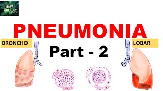 Pneumonia Part 2 Community acquired bacterial pneumonia  Lobar Vs Bronchopneumonia [upl. by Rowland]