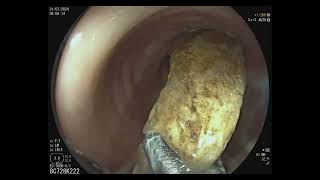 Sigmoid colon perforation [upl. by Willin]