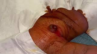 removal of granuloma from a hand [upl. by Sonitnatsnok]