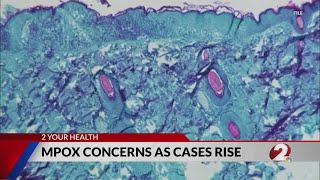 CDC WHO monitoring overseas outbreak of MPox What we know [upl. by Duwad]