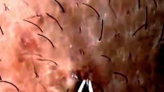 13 ingrown hair removal compilation vol 1 YouTube [upl. by Eirrab]