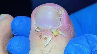 Removing Infected Ingrown Toenail [upl. by Perrie790]