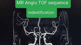 MR angio Tof sequences ko kese phchane MRI Angiography Brain Mri angio non Contrast MR TOF [upl. by Gar]