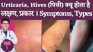 Skin Rash Urticaria Hives Causes Types Symptoms I Urticaria Hives Kyu Hota hai lakshan kya hai [upl. by Eire731]