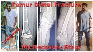 Distal Femur Fracture Recovery Part  1 [upl. by Yerkovich]