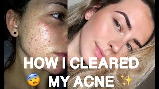 SKINCARE ROUTINEHOW I CLEARED MY ACNE [upl. by Naveb]