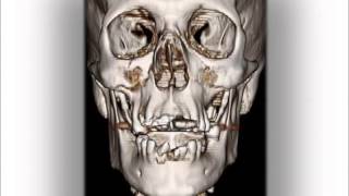 maxillofacial trauma [upl. by Tommy]