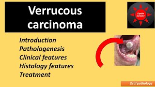 Verrucous carcinoma  oral pathology [upl. by Merline802]