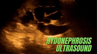 How to diagnose renal Hydronephrosis on ultrasound [upl. by Jd]