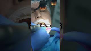 What Happens to The Abscess After Tooth Extraction  Dental Abscess  Daily Dentists [upl. by Robbi519]