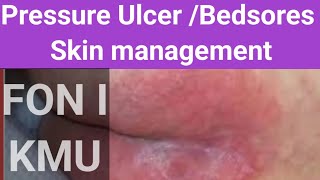 Bedsores  pressure ulcer skin management FON l KMU new 2024 [upl. by Eneja]