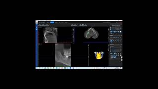 Romexis in CBCT [upl. by Dolora149]