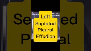 Septated Pleural Effusion  Lung Fluid  Dyspnoea ultrasound [upl. by Niassuh]