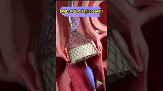 Artificial Heart Valve Replacement [upl. by Wendie979]