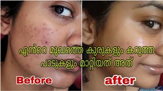 How to Remove Pimples amp dark spots Naturally at home in 2 weeksSimplyMyStyle Unni malayali beauty [upl. by Abate]