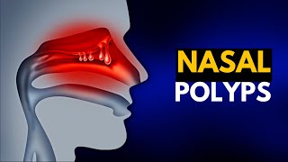 NASAL POLYPS Causes SIgns and Symptoms Diagnosis and Treatment [upl. by Alyt]