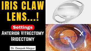 Iris Claw Lens in a case of Lens Induced GlaucomaUsing the Vitrector for IridectomyDr Deepak Megur [upl. by Rotciv]