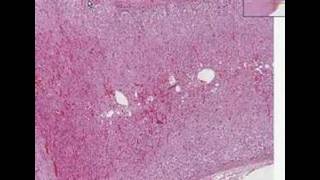 Histopathology AdrenalCortical adenoma [upl. by Anitnerolf172]