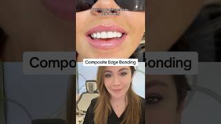 Composite Bonding To Improve The Edges Of Teeth [upl. by Thamos]