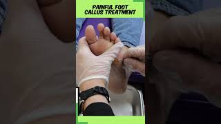 Callous Pain Relief Expert Removal Guide chiropody [upl. by Portia309]