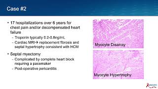 Heart Failure and HIV [upl. by Doris]