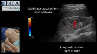 Episode 39 NephroUrolithiasis [upl. by Ahsok]