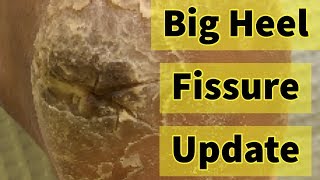 Big Heel Fissure Update The Heel Has Finally Healed [upl. by Peria718]