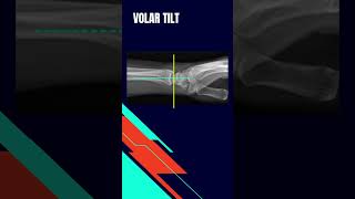 Distal radius fracture radiographic evaluation Volar tilt angle [upl. by Enoyrt]