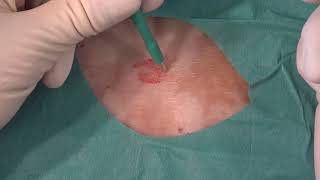 Stansebiopsi  Punch biopsy [upl. by Ramedlab]