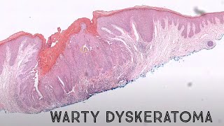 Warty Dyskeratoma acantholytic dyskeratosis pathology dermpath dermatology dermatopathology [upl. by Kriste]