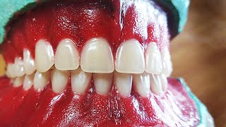 Denture Special carving or denture festooning for denture for natural esthetics in hindi [upl. by Attenborough]