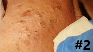 BIG BLACKHEADS EXTRACTIONS on Happy  2 [upl. by Itagaki]