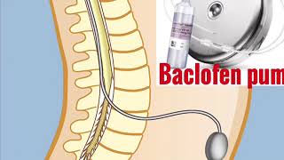 Baclofen pump for paralytic patients [upl. by Idnarb]