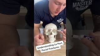 Understanding Le Fort Facial Fractures [upl. by Dickie]