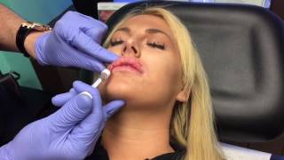 Microdroplet lip injection Using Restylane Juvederm [upl. by Abramson339]