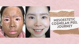 Cosmelan Treatment by Mesoestetic  Removal of Freckles Melasma amp Pigmentation [upl. by Ikik612]