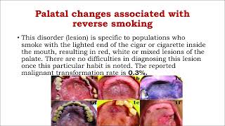 Oral surgery L10 Premalignant Lesions [upl. by Mcdougall538]