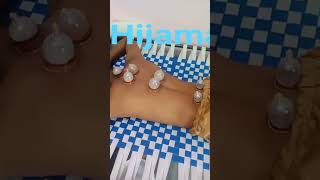 hijama hijamacupping hijamatherapy [upl. by Jemmy417]