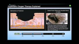 Patient Education Simulation for Hyperbaric Oxygen Therapy [upl. by Ahsenom]